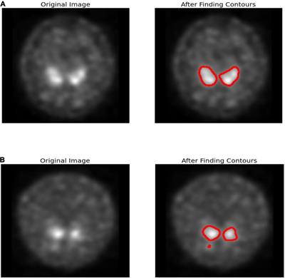 Soft Attention Based DenseNet Model for Parkinson’s Disease Classification Using SPECT Images